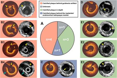 Calcified plaque detected on OCT with deep learning and cross-validated with optical and ultrasound signals: A complementary appraisal and preamble to combined IVUS-OCT catheter